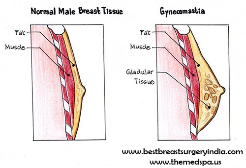 gynecomastia-surgery-by-drajayakashyap
