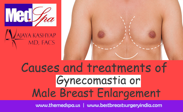 Causes and treatments of Gynecomastia or Male Breast Enlargement